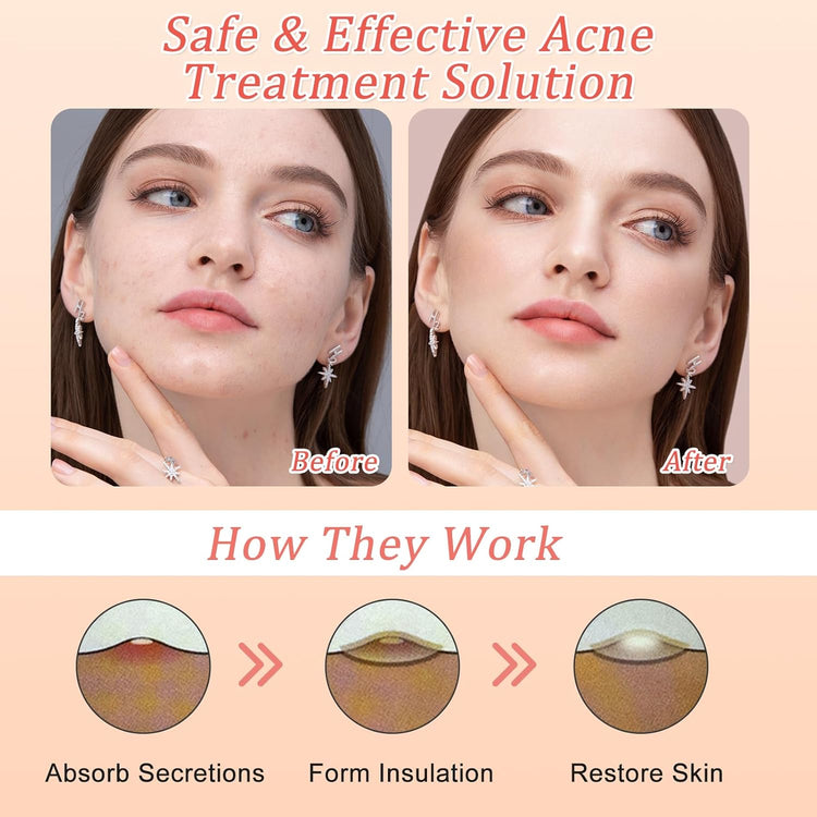 Pimple Patches for Face,144Pcs Hydrocolloid Acne Patches, Absorbing Cover Invisible Blemish Spot Patches, Spot Treatment Stickers Effectively Calm & Relieves Acne Facial Skin Care